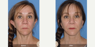 Case 9336 - 55-64 year old woman treated with Facelift, Neck Lift