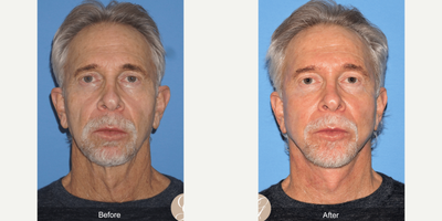 Case 9337 - 65-74 year old man treated with Facelift, Neck Lift