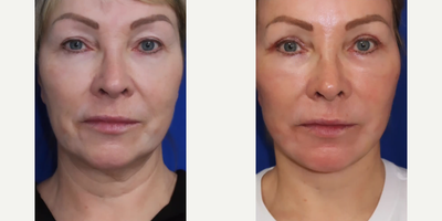 Case 9338 - Woman treated with Facelift, Neck Lift, CO2 Laser, Eyelid Surgery