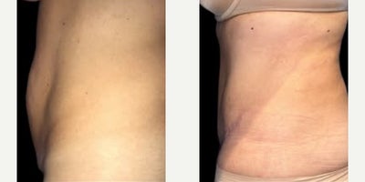 Case 934 - Woman treated with Tummy Tuck