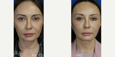 Case 9341 - Woman treated with Neck Lift