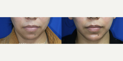 Case 9342 - Woman treated with Neck Lift, Facelift, Chin Liposuction