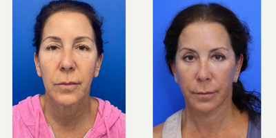 Case 9345 - 55-64 year old woman treated with Facelift, Neck Lift, Eyelid Surgery, Facial Fat Transfer, Laser Resurfacing