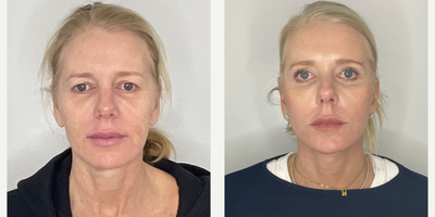 Case 9346 - 55-64 year old woman treated with Facelift, Neck Lift, Eyelid Surgery, Facial Fat Transfer, Laser Resurfacing, CO2 Laser