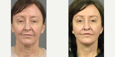 Case 9347 - Woman treated with Deep Plane Facelift, Neck Lift