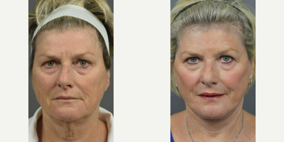 Case 9348 - Woman treated with Deep Plane Facelift, Neck Lift, Laser Resurfacing