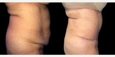 Case 935 - Woman treated with Tummy Tuck