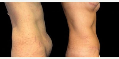 Case 936 - Woman treated with Tummy Tuck