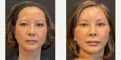 Case: 9451 - before and after photo of 45-54 year old woman treated with Facelift, Eyelid Surgery, Neck Lift, Buccal Fat Removal, Brow Lift by Adam Bryce Weinfeld, MD