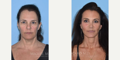 Case: 9452 - before and after photo of Woman treated with Brow Lift by Miguel Mascaro, MD