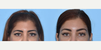 Case: 9453 - before and after photo of Woman treated with Brow Lift by Miguel Mascaro, MD