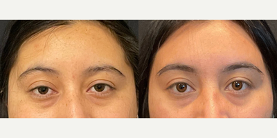 Case: 9454 - before and after photo of Woman treated with Brow Lift by Adam Bryce Weinfeld, MD