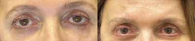 Case: 9455 - before and after photo of 68 year old woman treated with Brow Lift by Mansher Singh, MD, FACS