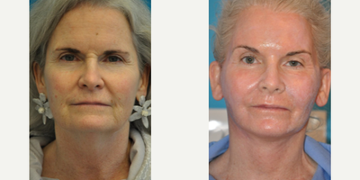 Case: 9456 - before and after photo of Woman treated with Brow Lift by Barry M. Weintraub, MD, FACS