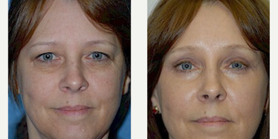 Case: 9457 - before and after photo of Woman treated with Brow Lift by Andrew Miller, MD