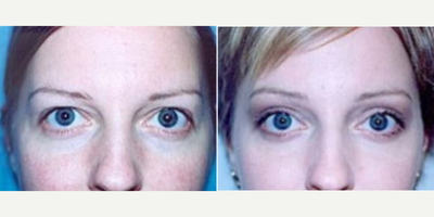 Case: 9458 - before and after photo of Woman treated with Brow Lift by Andrew Miller, MD