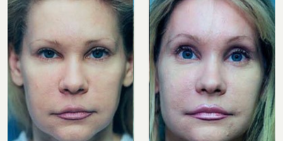 Case: 9459 - before and after photo of Woman treated with Brow Lift by Andrew Miller, MD