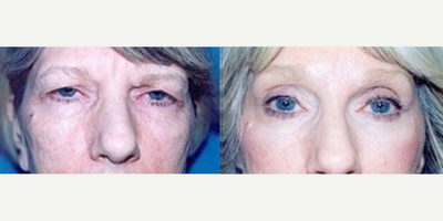 Case 9460 - Woman treated with Brow Lift