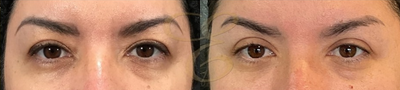 Case 9462 - Woman treated with Eyelid Surgery, Brow Lift