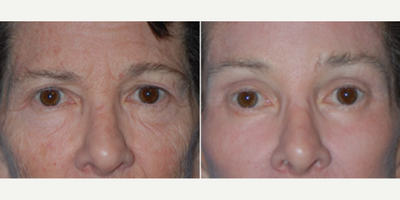Case 9463 - Woman treated with Brow Lift