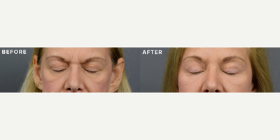 Case 9464 - Woman treated with Brow Lift, Eyelid Surgery