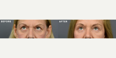 Case 9465 - Woman treated with Brow Lift, Eyelid Surgery
