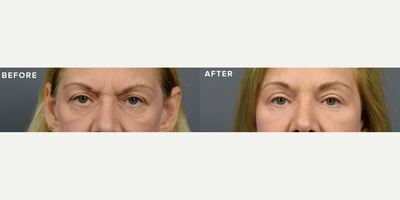 Case 9466 - Woman treated with Brow Lift, Eyelid Surgery