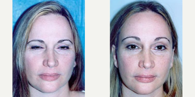 Case 9467 - Woman treated with Brow Lift