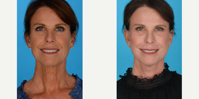 Case 9470 - Woman treated with Brow Lift