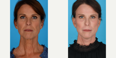 Case 9471 - Woman treated with Brow Lift