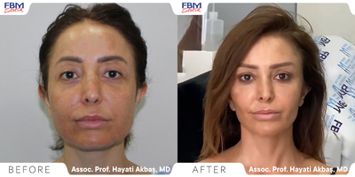 Case 9474 - 35-44 year old woman treated with Mini Facelift, Brow Lift, Facial Fat Transfer