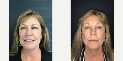 Case 9477 - Woman treated with Brow Lift