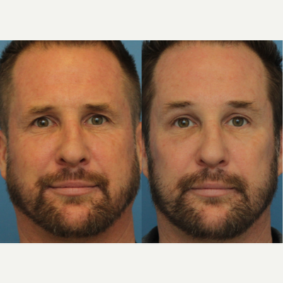 Case 9478 - 45-54 year old man treated with Brow Lift