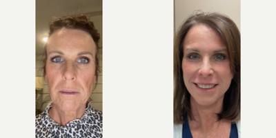 Case 9479 - Facial Rejuvenation