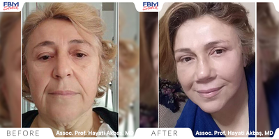 Case 9485 - 45-54 year old woman treated with Facelift, Neck Lift, Rhinoplasty, Eyelid Surgery, Brow Lift, Facial Fat Transfer