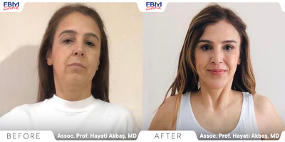 Case 9486 - 45-54 year old woman treated with Brow Lift, Eyelid Surgery, Buccal Fat Removal, Lip Lift, Facial Fat Transfer