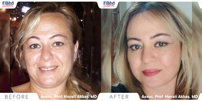Case 9487 - 35-44 year old woman treated with Facelift, Neck Lift, Eyelid Surgery, Brow Lift, Facial Fat Transfer