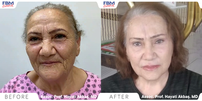 Case 9488 - 55-64 year old woman treated with Deep Plane Facelift, Double Eyelid Surgery, Neck Lift, Facial Fat Transfer, Brow Lift