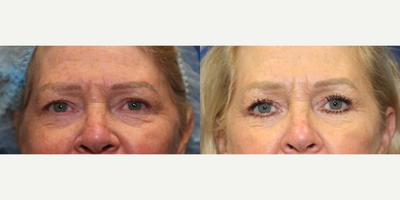 Case 9489 - 55-64 year old woman treated with Brow Lift