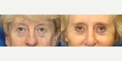 Case 9490 - 55-64 year old woman treated with Brow Lift