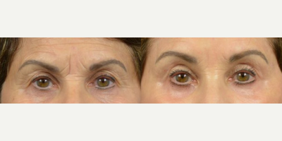 Case 9491 - Woman treated with Eyelid Surgery, Brow Lift