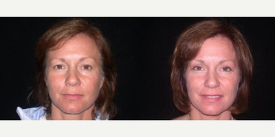 Case 9493 - Woman treated with Brow Lift