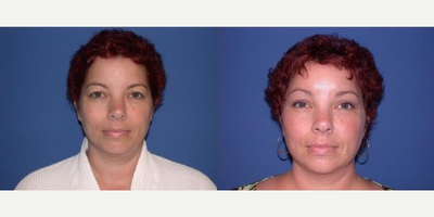 Case 9494 - Woman treated with Brow Lift