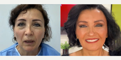 Case 9495 - 56 year old woman treated with Brow Lift