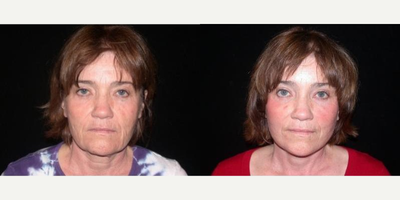 Case 9496 - Woman treated with Brow Lift, Lower Facelift, Neck Lift
