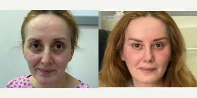 Case 9498 - 42 year old woman treated with Brow Lift