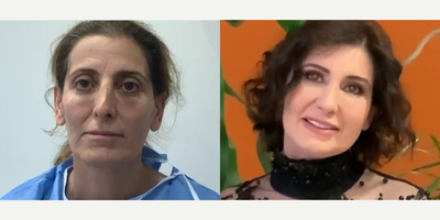 Case 9501 - 49 year old woman treated with Brow Lift