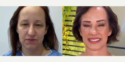 Case 9503 - 51 year old woman treated with Brow Lift