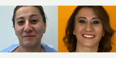 Case 9504 - 36 year old woman treated with Brow Lift