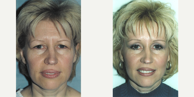 Case 9506 - Brow Lift